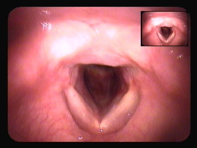 扁桃炎 のどの痛みの治療は足立区ひろい耳鼻咽喉科クリニックへ